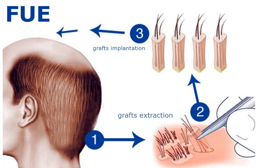 Follicular Unit Extraction