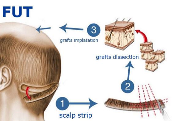 Follicular Unit Transplantation