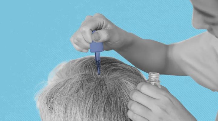 Best Hair Transplant Alternatives