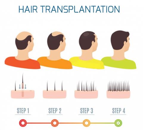 Follicle Implantation: